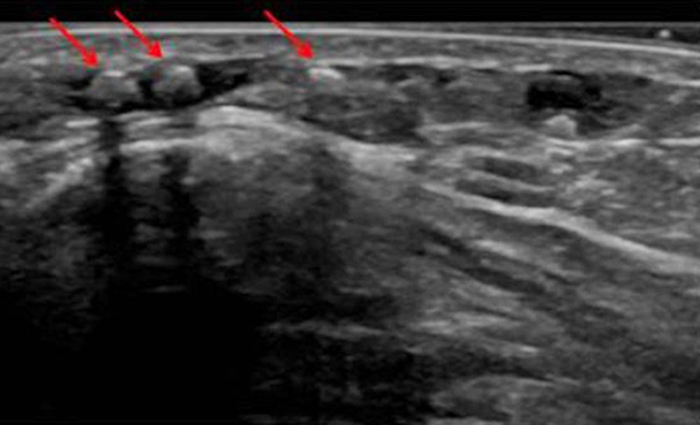 Sonography: phleboliths