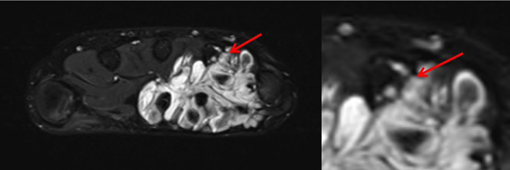 MRI: thrombi