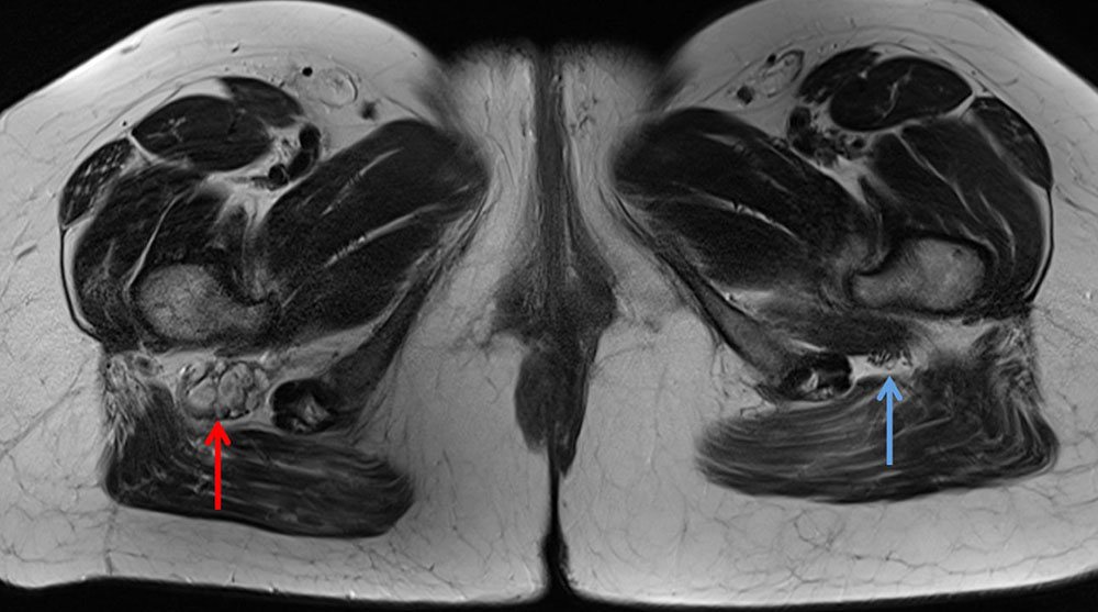 MRI: sciatic nerve