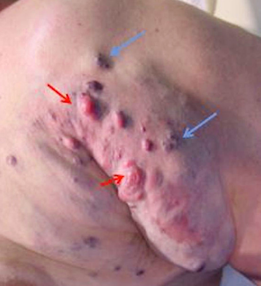 Foam sclerotherapy for large axillary venous malformation