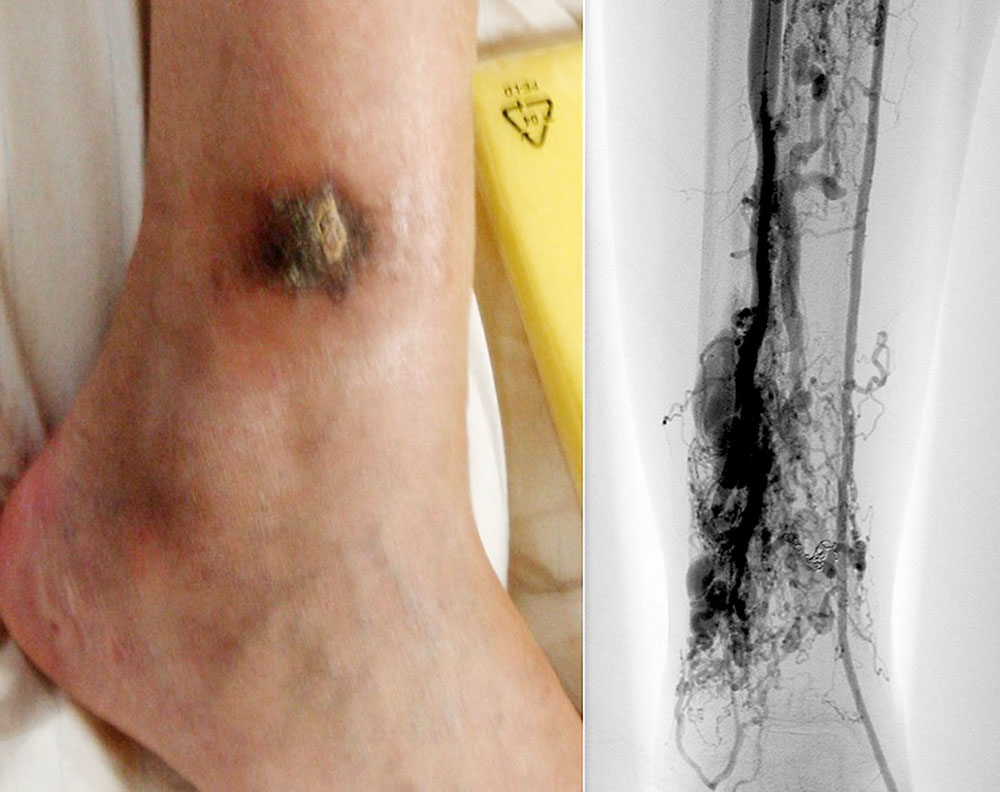 Angiography: ulcer on the distal lateral lower leg
