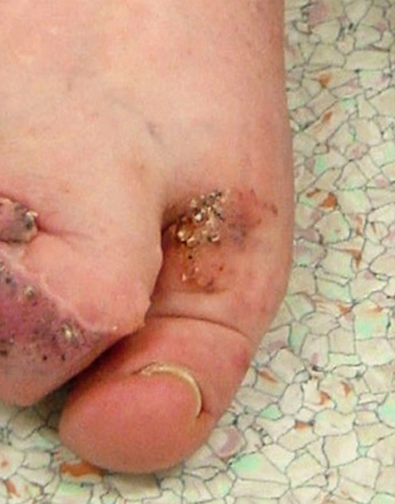 Combined capillary-veno-lymphatic malformation between the 1st and 2nd toes