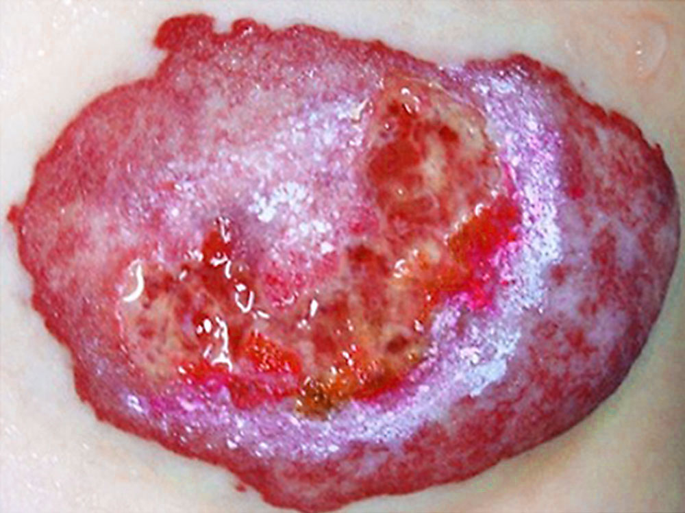 Ulceration of an infantile hemangioma