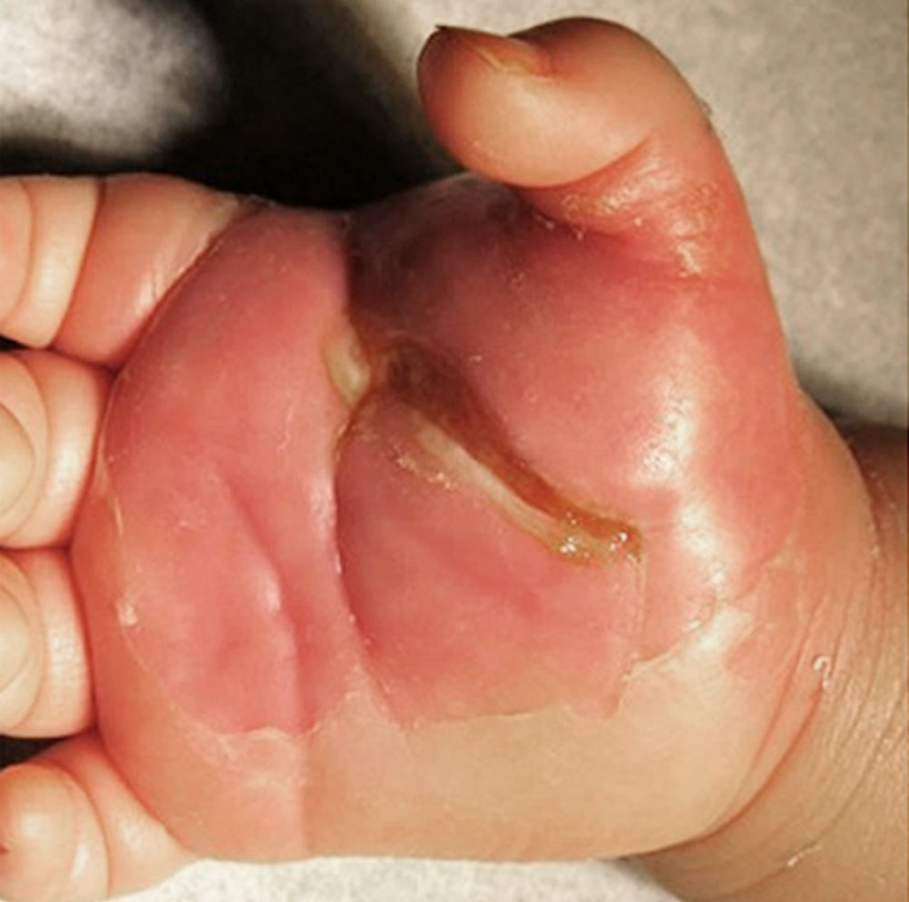 Wound infection with redness, swelling, exudation and purulent wound secretion