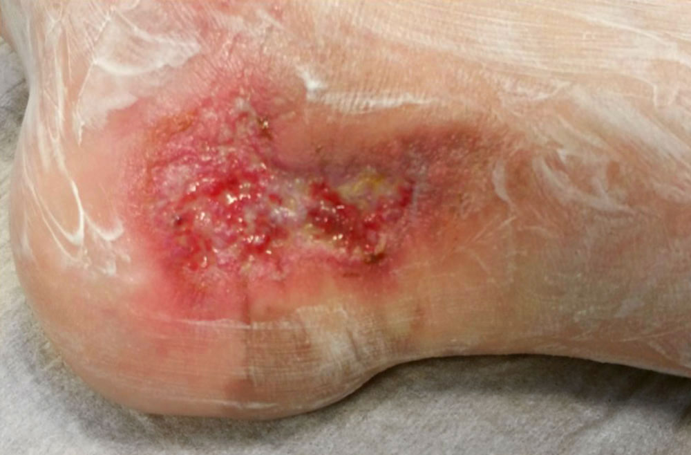 Dorsal ulcer of the lateral malleolus superinfected