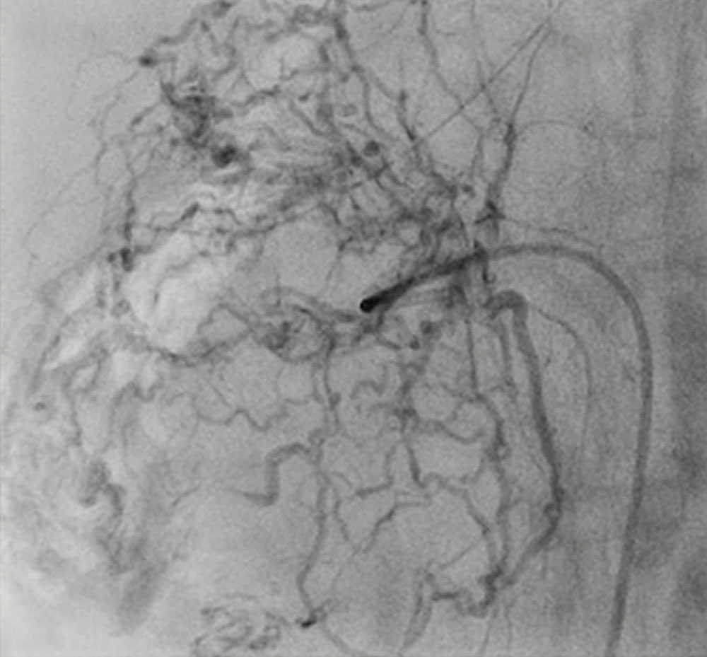 Giant arteriovenous malformation in the liver in a neonate