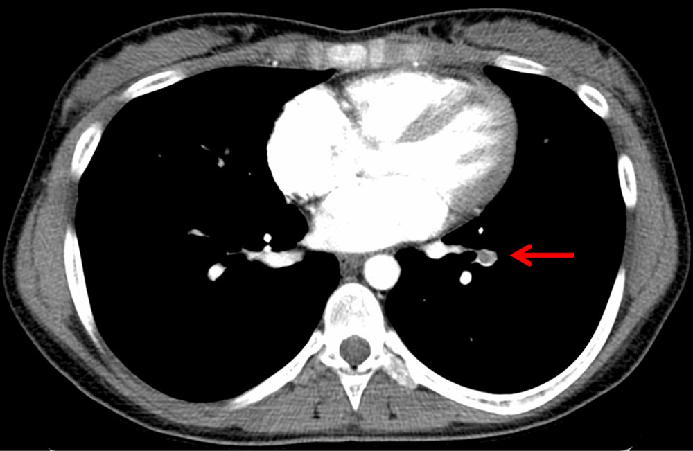 CT: pulmonary embolism in a patient with Klippel-Trénaunay syndrome