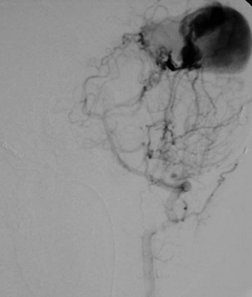 DSA: Giant aneurysm in vein of Galen malformation in an infant