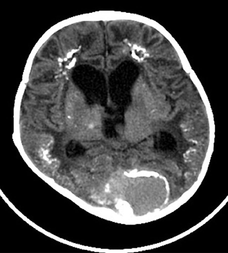 CT: hydrocephalus, large aneurysm, multiple calcifications
