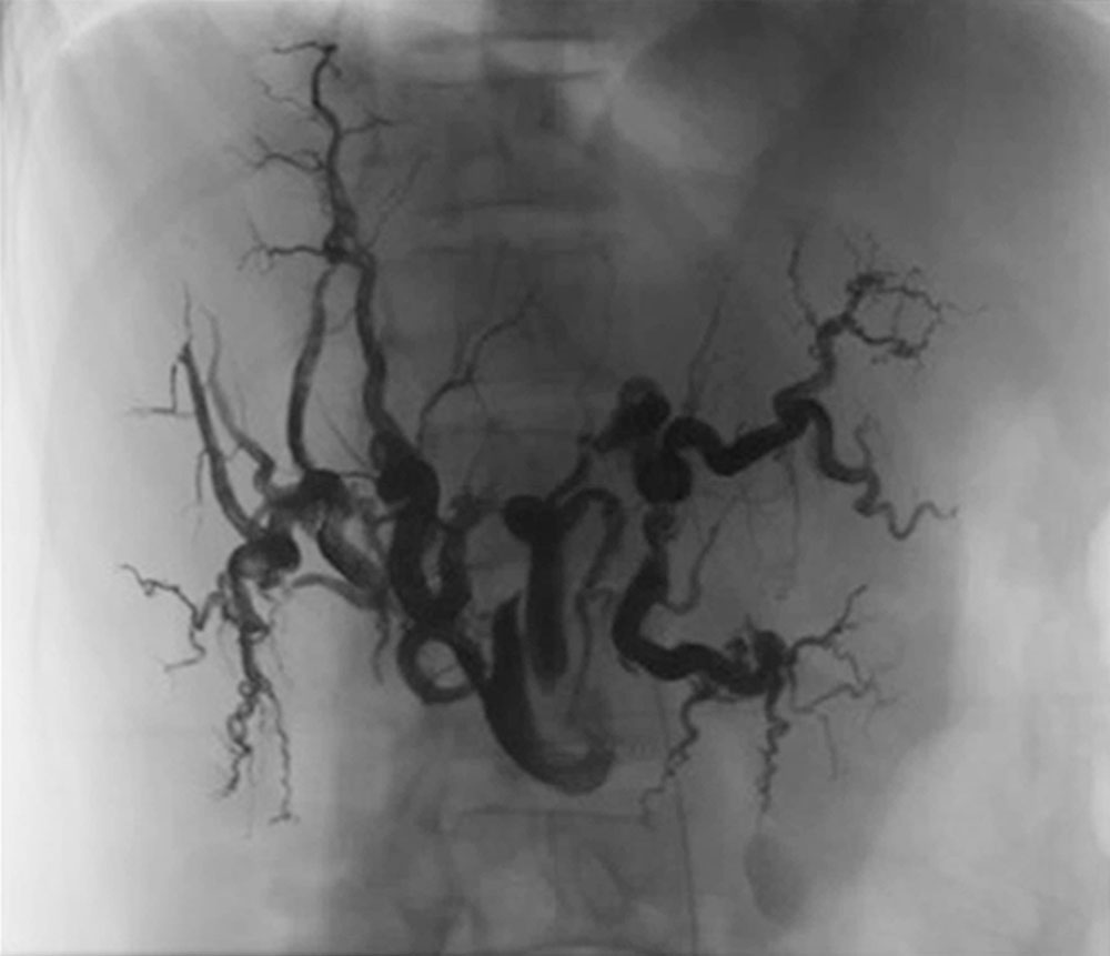 Embolization of a giant hepatic AVM in a female HHT patient