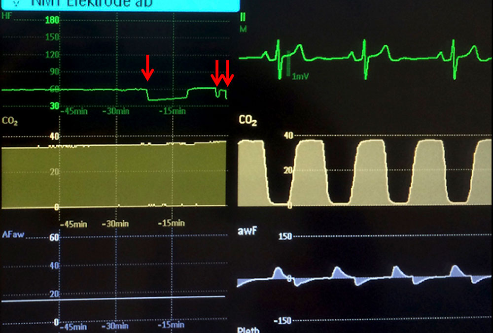 Nicoladoni-Branham sign in trend monitoring of heart rate