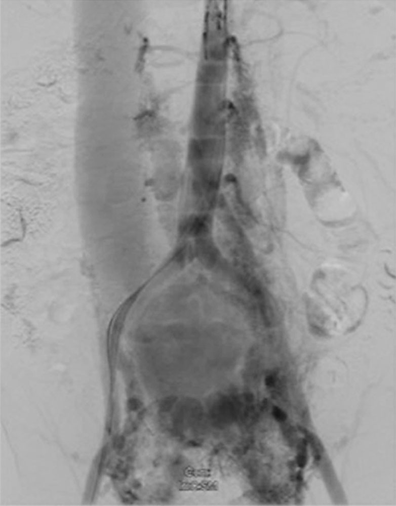 DSA: huge abdominal arteriovenous malformation