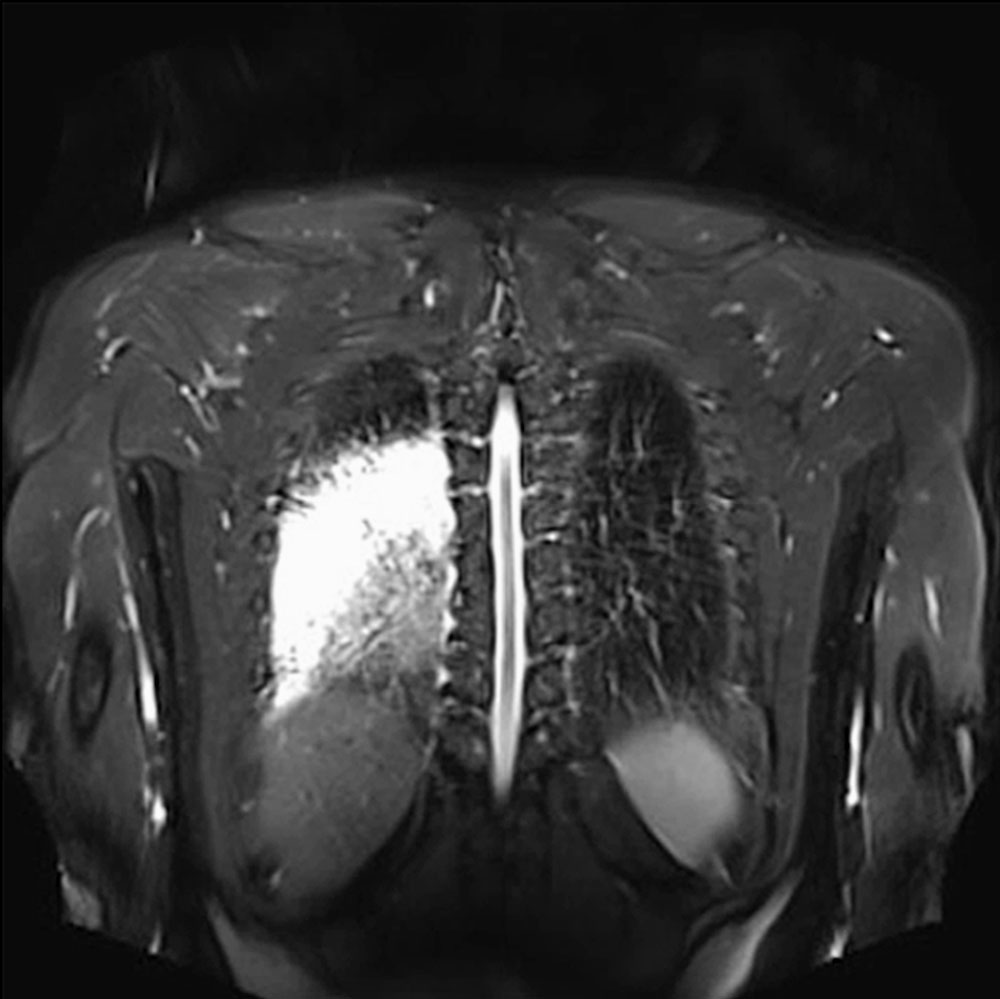 MRI: Pneumonia in a patient with large arteriovenous malformation