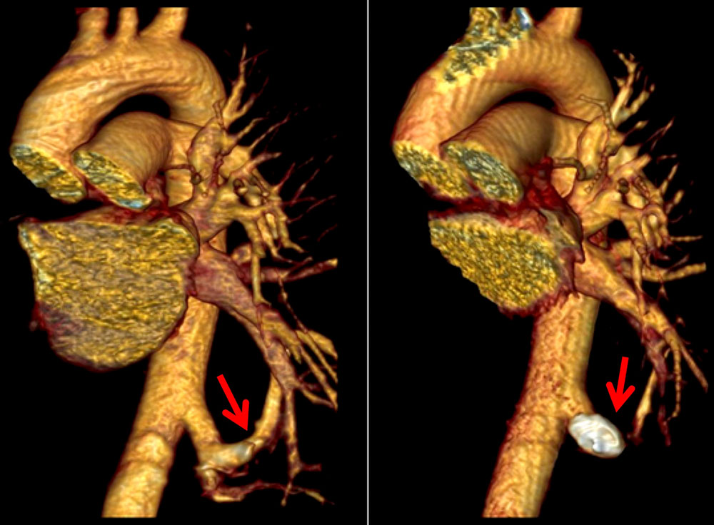 Congenital arteriovenous fistula