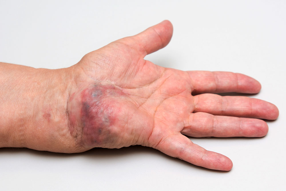 Arteriovenous malformation of the hand – ten years after the first intervention