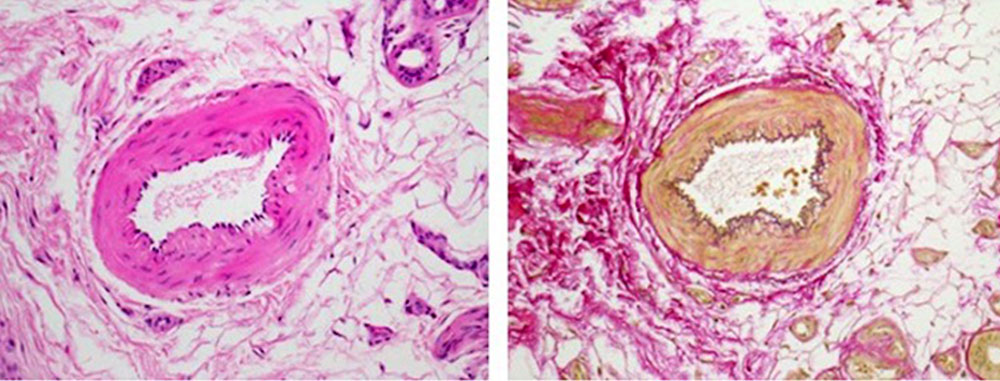 Vein in H&E and in EvG staining