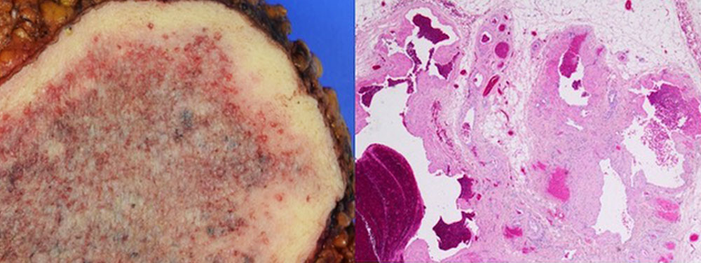 Histological example of a venous malformation