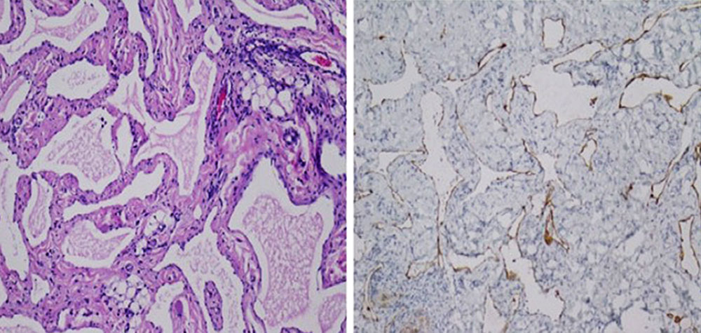 Histological example of a lymphatic malformation