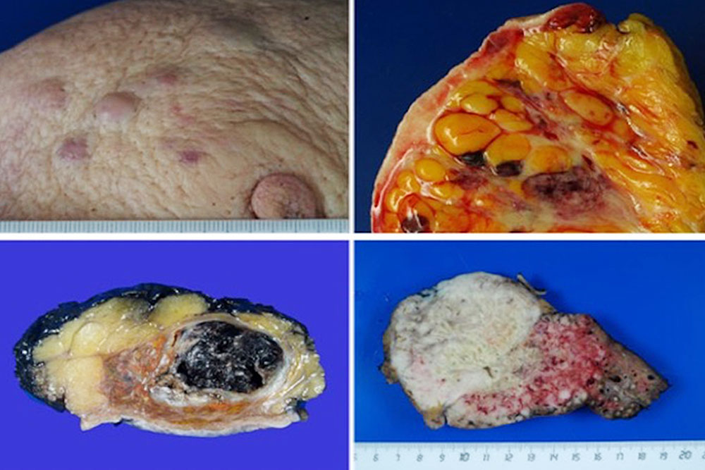 Macroscopic examples of angiosarcomas