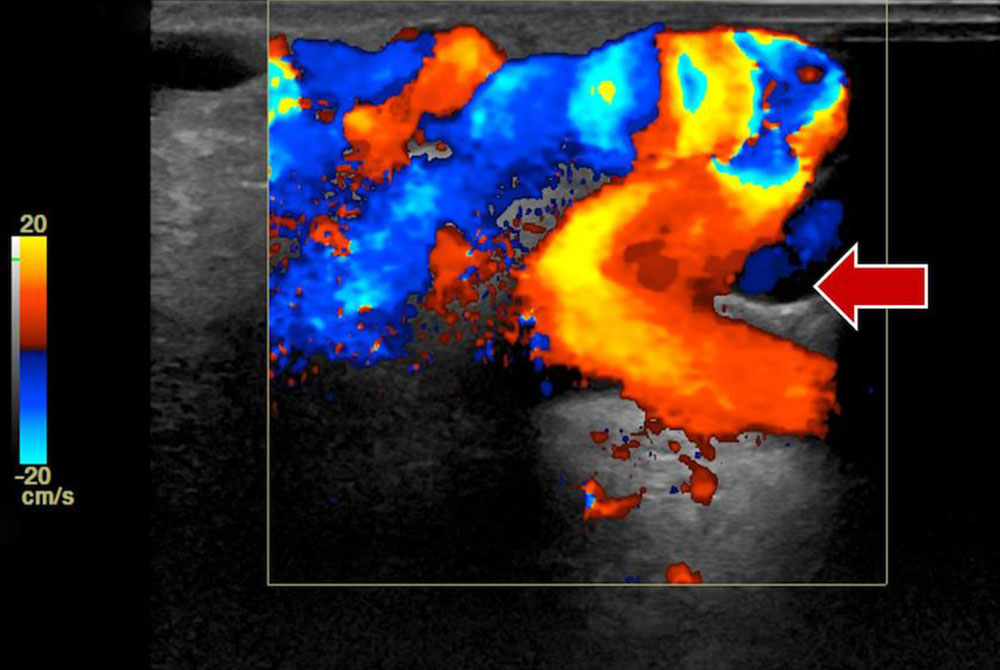Color-coded duplex sonography of an arteriovenous malformation