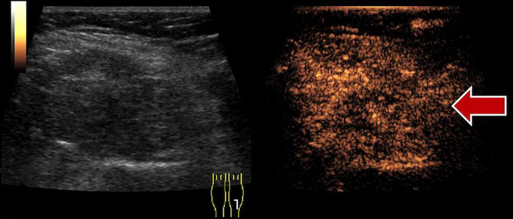 Sonography of a venous malformation