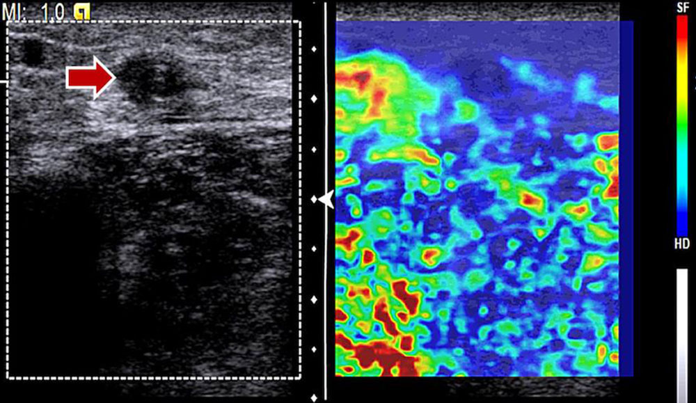 Elastography of a dysplastic vein