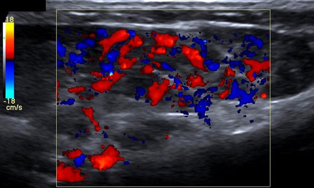 Hyperperfusion on CCDS in a case of infantile hemangioma