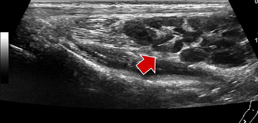 Typical findings of a venous malformation