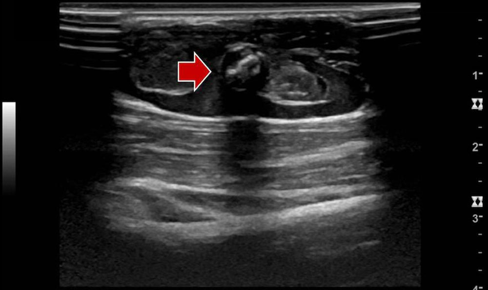 Phlebolith within a venous malformation