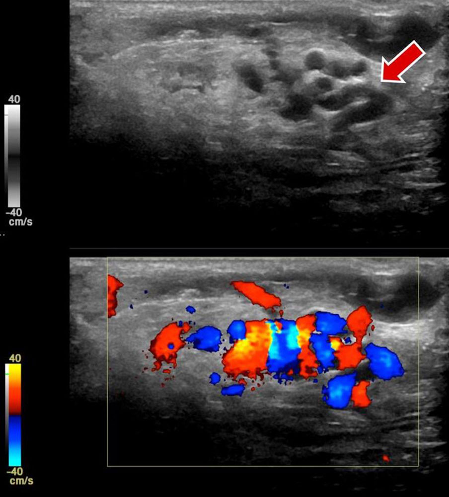 Arteriovenous malformation on CCDS