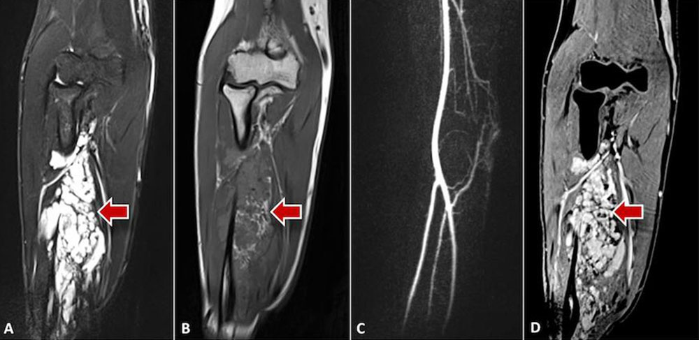 Typical appearance of a venous malformation 