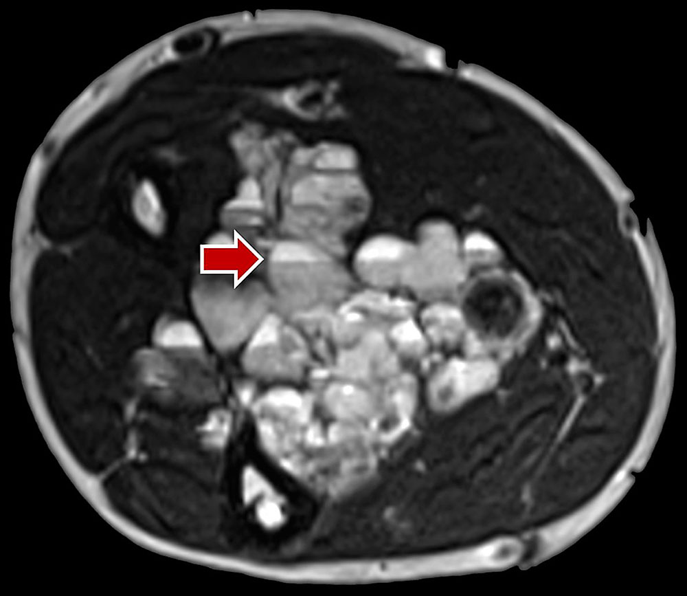 Multiple fluid-fluid levels on a venous malformation