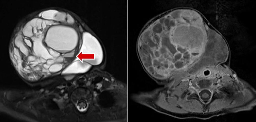 Macrocystic lymphatic malformation with “fluid-fluid level” within a cyst