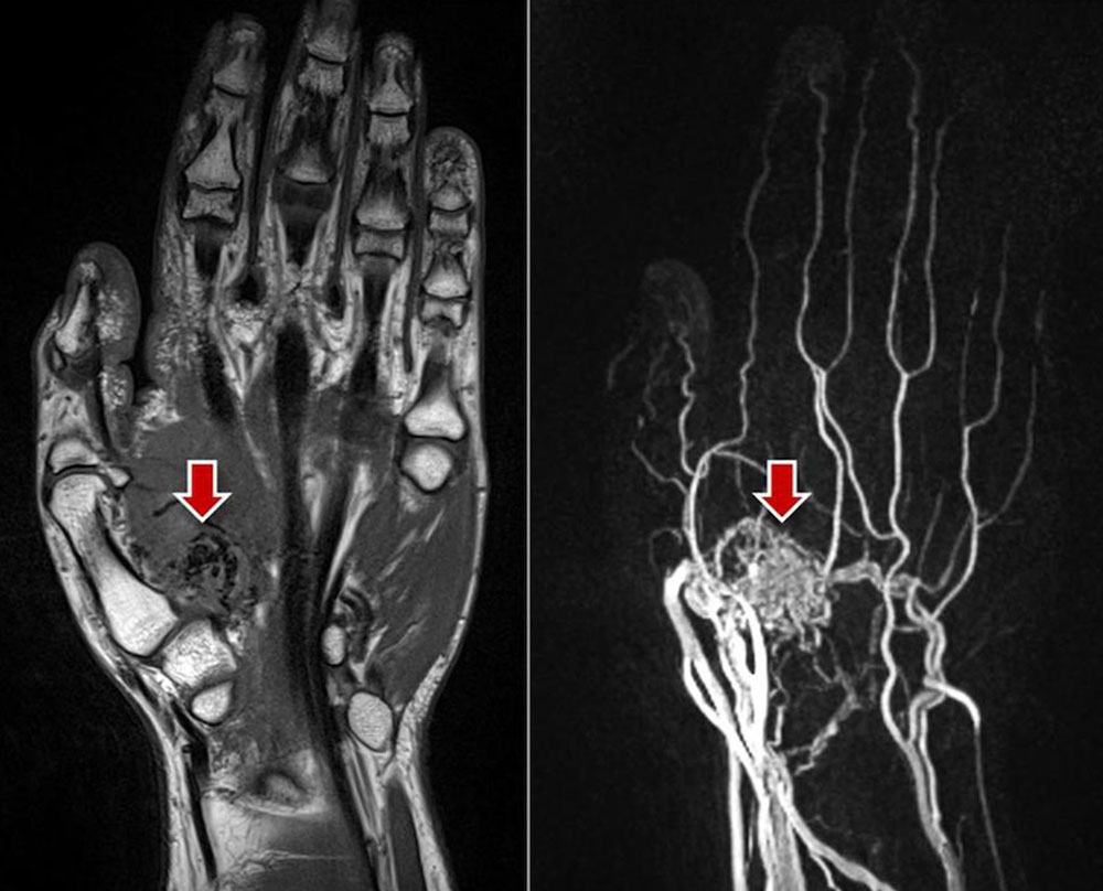 Arteriovenous malformation of the hand