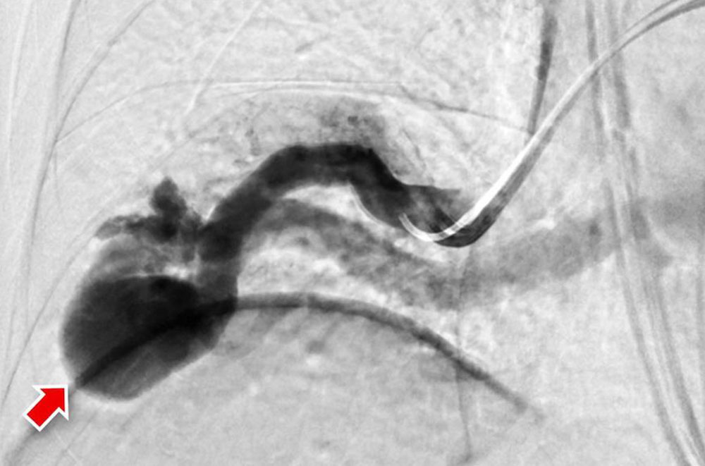 DSA of an arteriovenous fistula