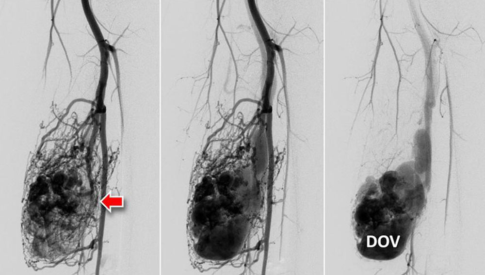 DSA of a type II arteriovenous malformation