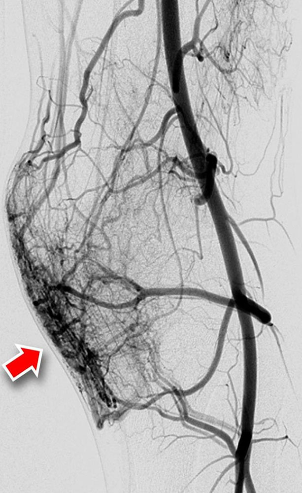 DSA of a type IIIa arteriovenous malformation