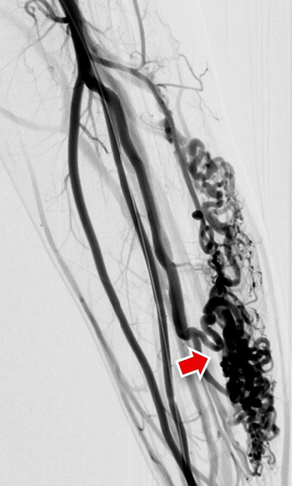 DSA of a type IIIb arteriovenous malformation