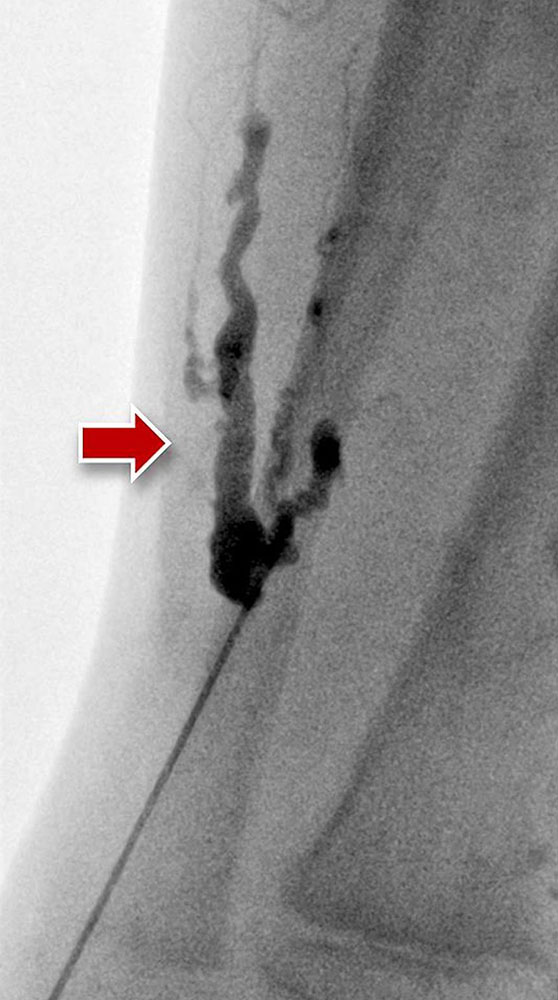 Tubular venous malformation