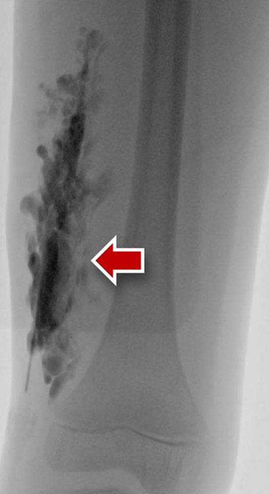 Spongiform venous malformation