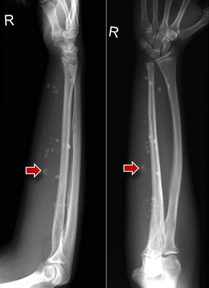 Phleboliths in conventional X-ray