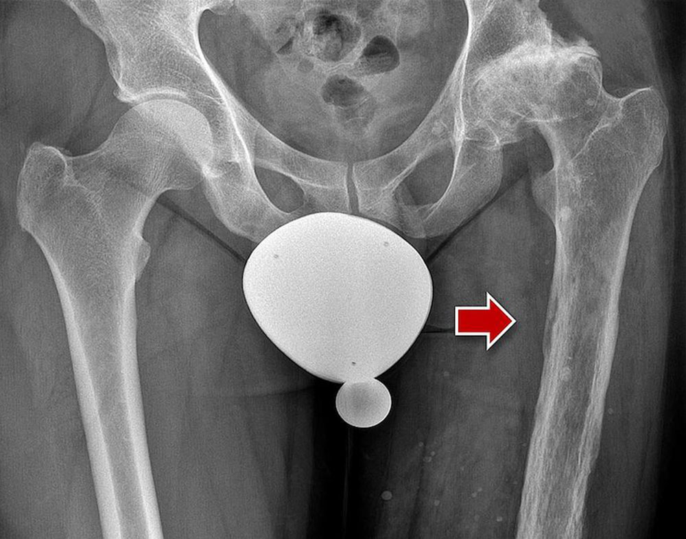 Venous malformation of the leg