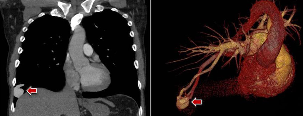 Angiography of a pulmonary AV malformation