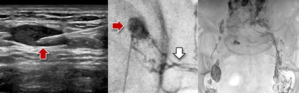 Ultrasound-guided image of a groin lymph node