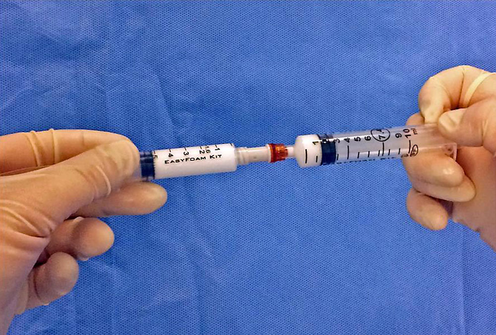 Foamed polidocanol