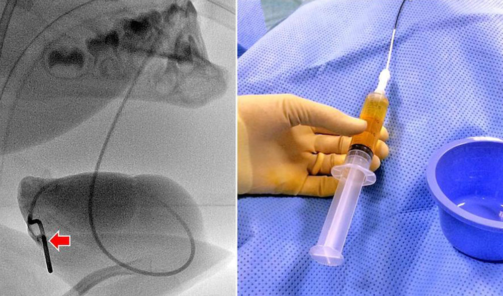 Pigtail catheter in a macrocystic lymphatic malformation