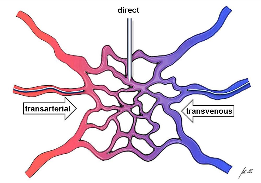 Vrterial, venous or direct puncture