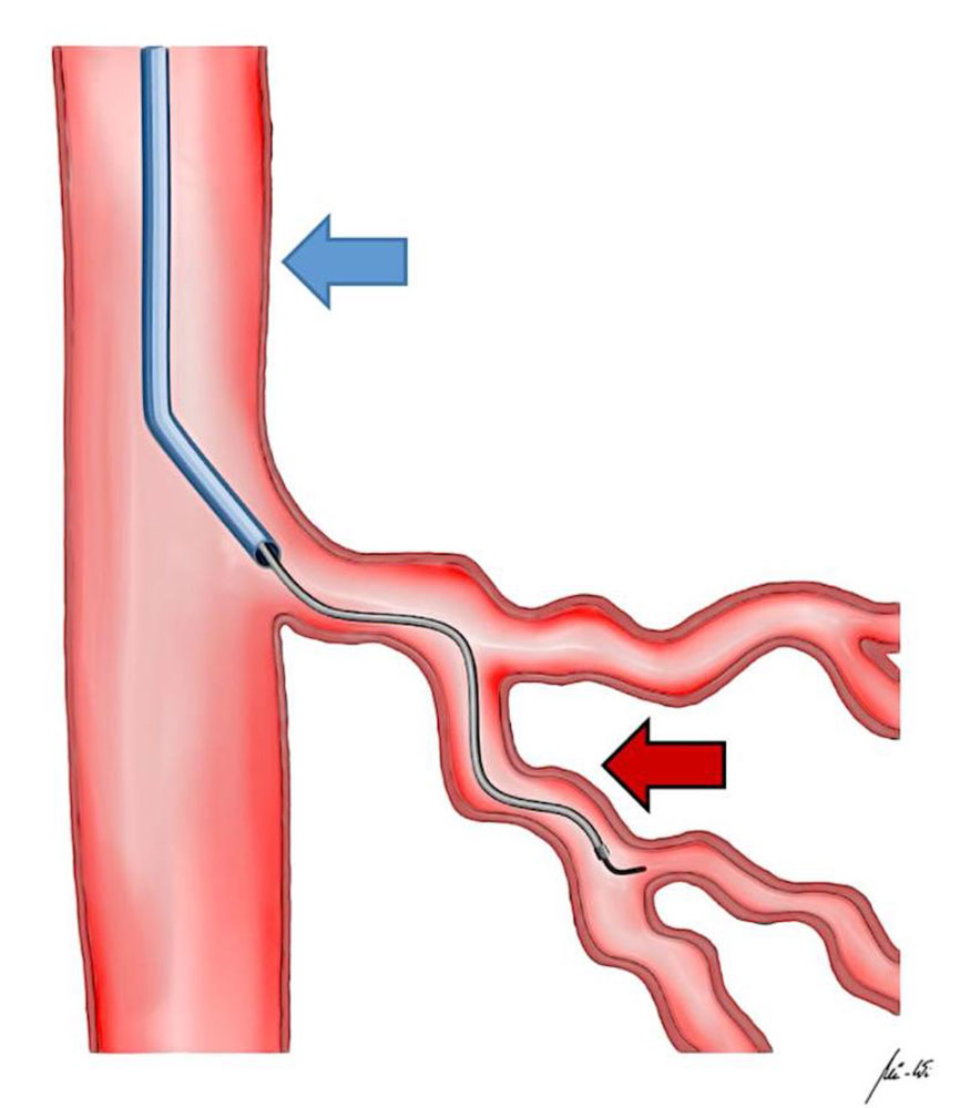 Catheters are maneuvered in the vascular system