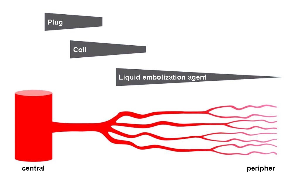 Occlusion levels of various embolization materials