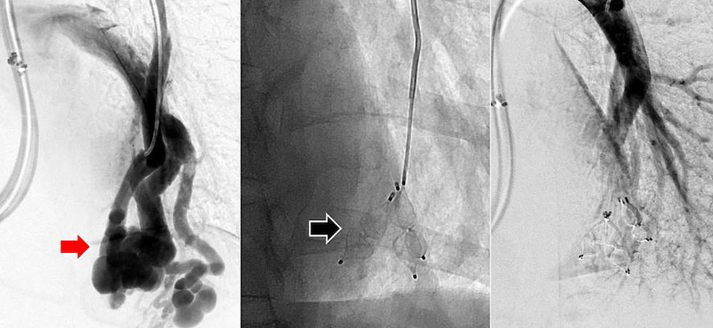 Occlusion with three AVP-II plugs